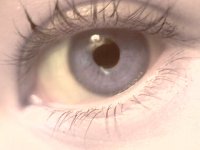 Eye
